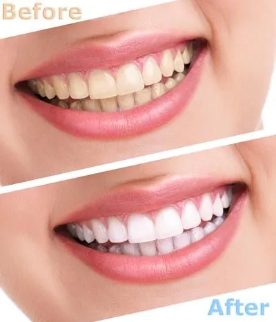 before and after look at teeth whitening services offered at Strawberry Village Dental Care