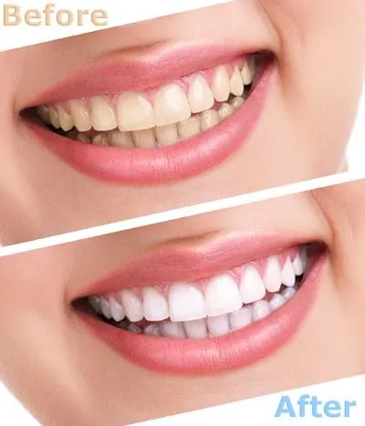 before and after look at teeth whitening services offered at Strawberry Village Dentist