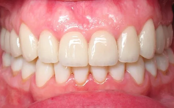 After image