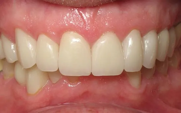 After image